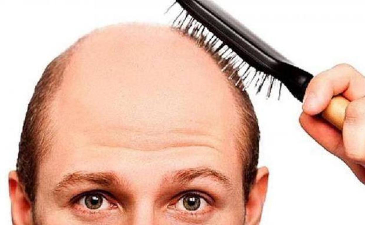 Pandemia de covid-19 | ¿Tienen los calvos más riesgo de entrar en UCI por covid-19?