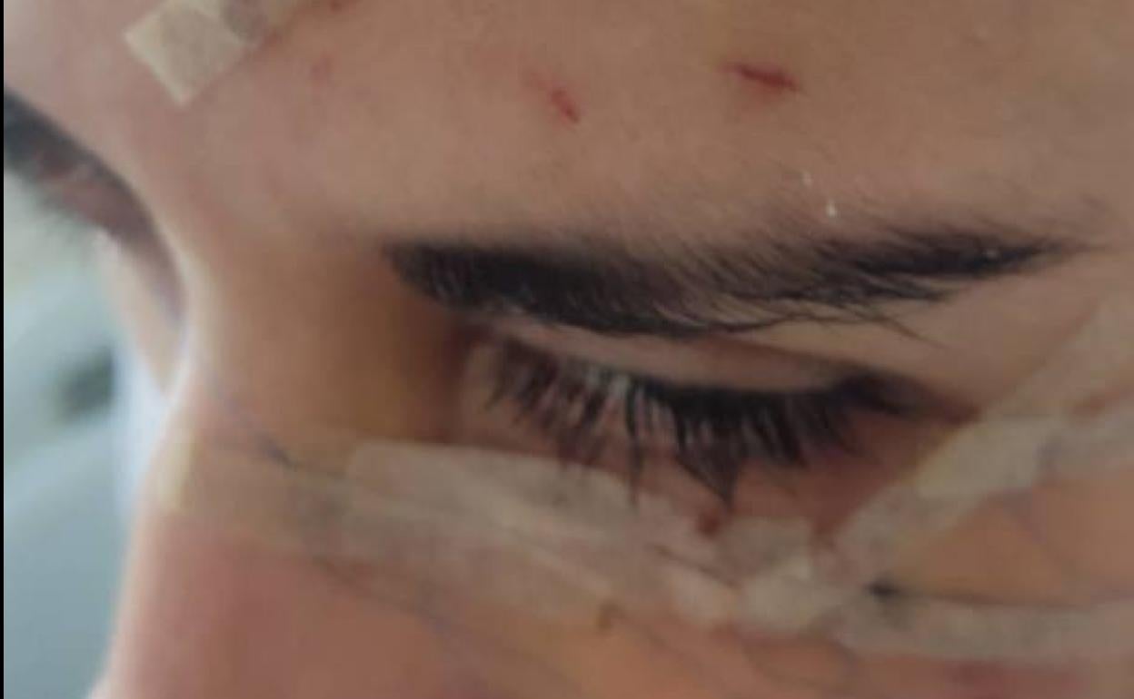 Imagen de la zona del ojo y párpado dañada en el ataque. 