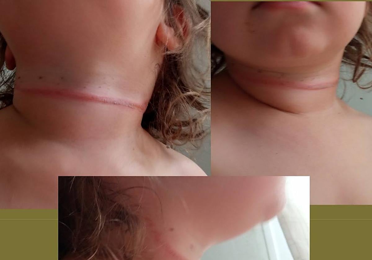 Quemadura en el cuello de la menor por una cuerda que se le quedó enrollada al tirarse del tobogán.
