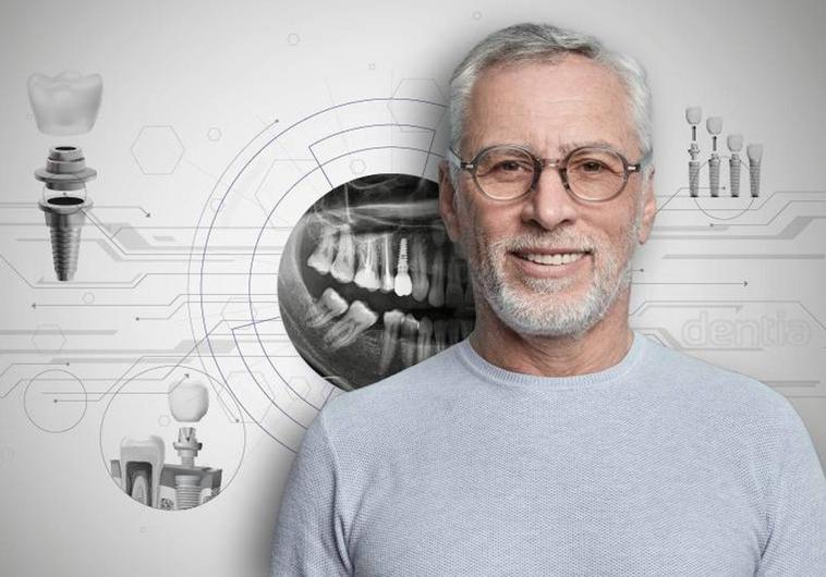 Descubre los implantes dentales de última generación La revolución en la odontología moderna Descubre los implantes dentales de última generación La revolución en la odontología moderna