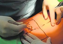 Foto de archivo de una cirugía de estómago.