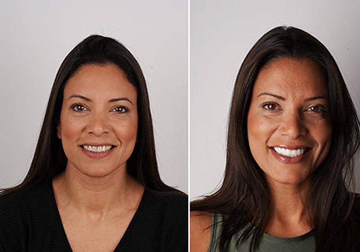 Ortodoncia: La solución efectiva para alinear tus dientes