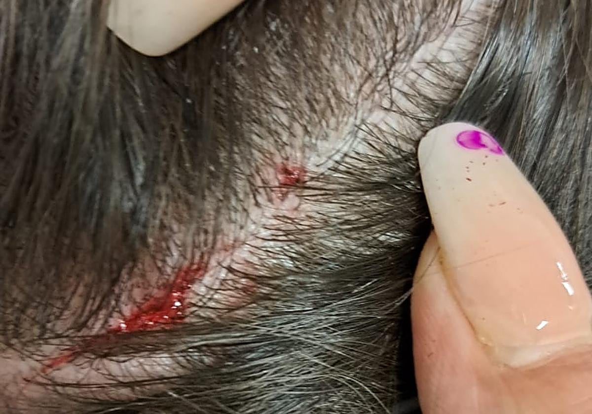 Algunas de las heridas de la menor provocadas por la agresión en Santa Fe.