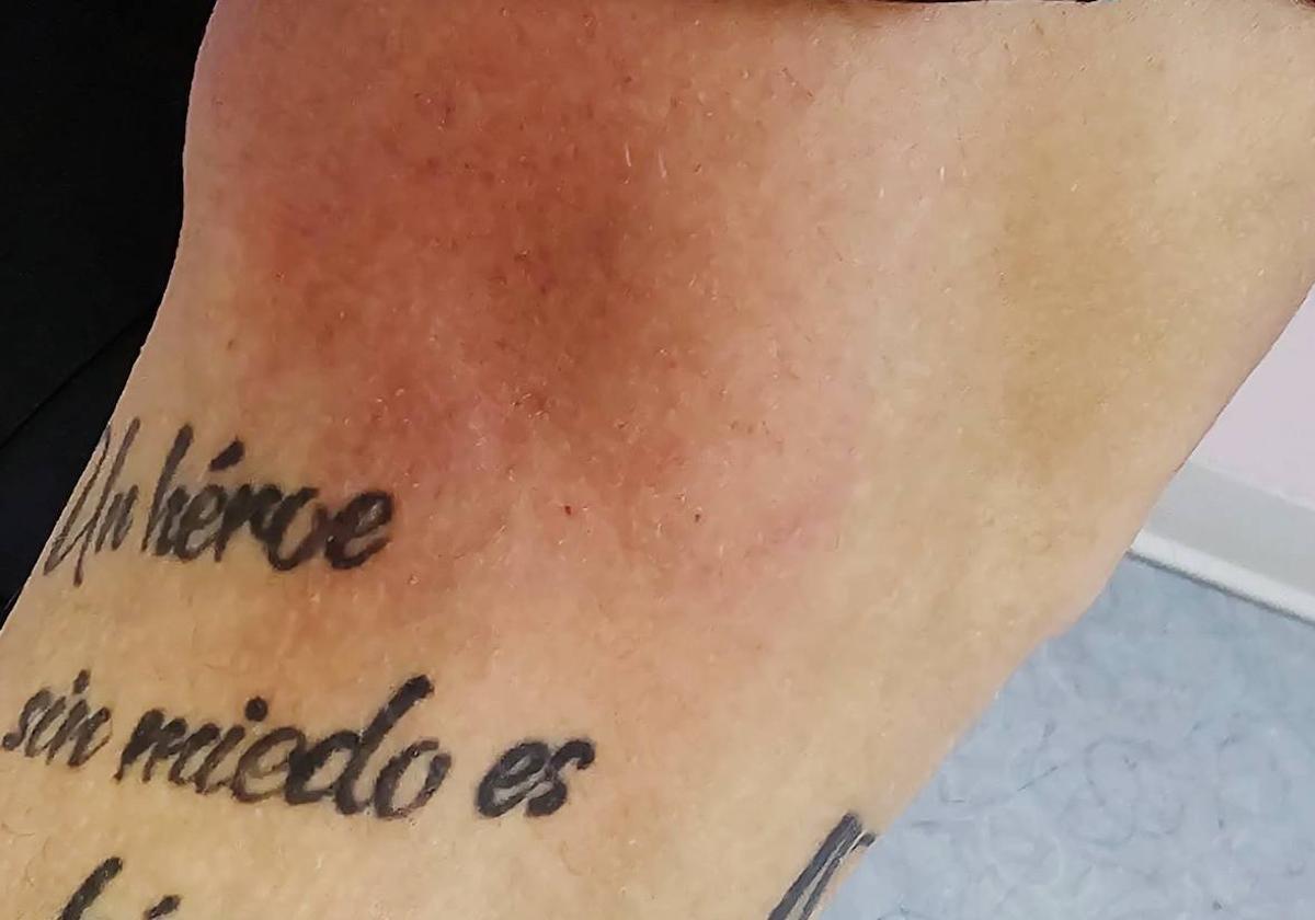 Hematoma en una de las piernas del auxiliar de seguridad agredido el pasado 4 de junio.