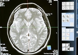 Imagen de un cerebro para valorar el tratamiento del ictus