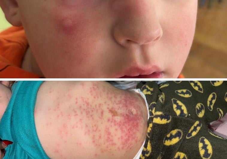 Varios niños afectados por una plaga de procesionaria en un pueblo de Granada