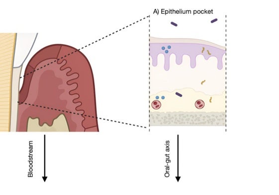 La periodontitis favorece el cáncer colorrectal al liberar CEA e IL-6 en la sangre y diseminar bacterias como Fusobacterium nucleatum, lo que altera la microbiota intestinal, reduce las defensas antitumorales y crea un ambiente proinflamatorio que promueve tumores.