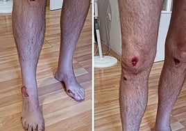 Quemaduras tras ser arrastrado varios metros.