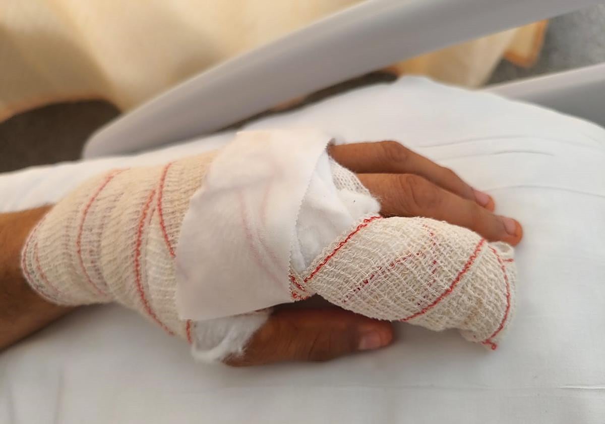 Estado de la mano del agente que sufrió la agresión en Garrucha.