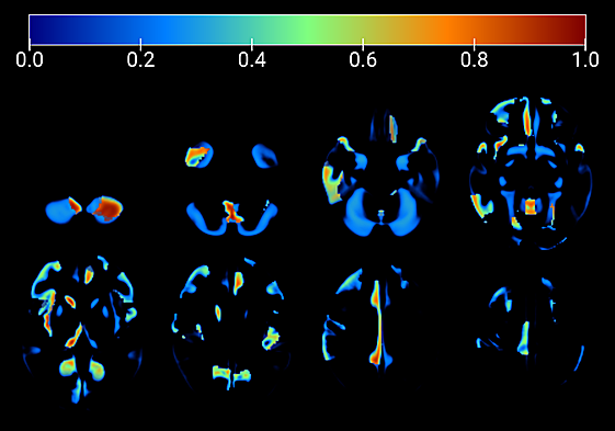 Imágenes de un cerebro afectado por enfermedad de Alzhéimer.