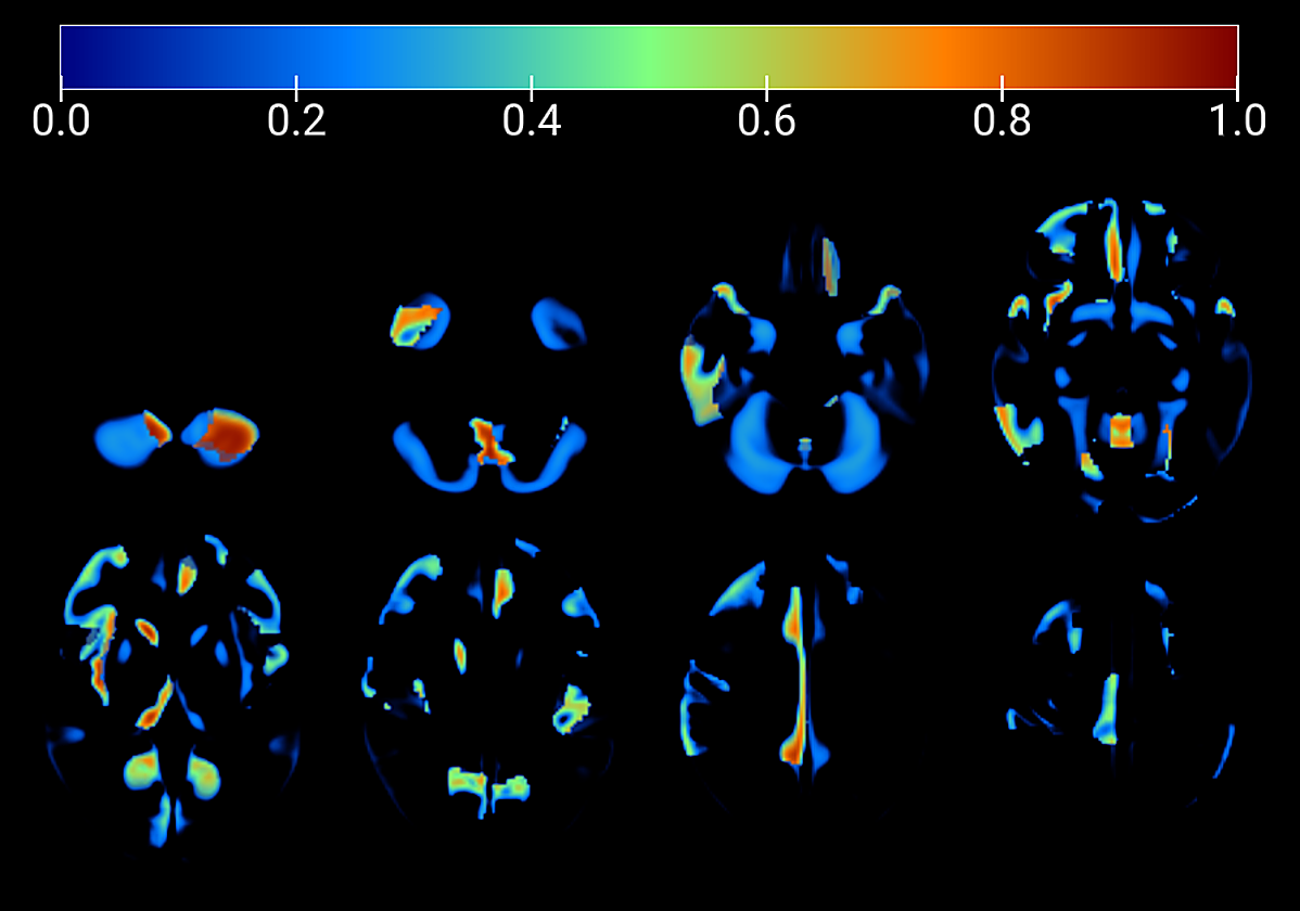 Imágenes de un cerebro afectado por enfermedad de Alzhéimer.