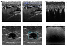 Un sistema de inteligencia artificial permite identificar rellenos estéticos en la piel mediante ecografías