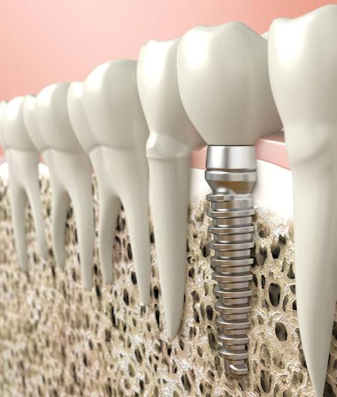 El PRGF logra que se produzca una regeneración ósea alrededor del implante. 