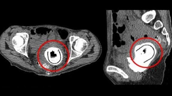 Una mujer tenía un juguete sexual de 13 cms en su vagina desde hacía 10 años