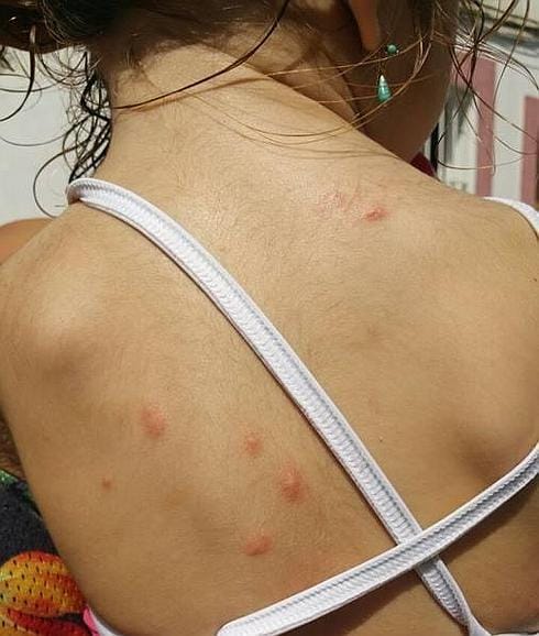 Espaldas y piernas han sido atacadas por unos insectos que dan miedo.