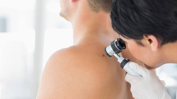 Cómo un lunar puede convertirse en alerta de cáncer de piel