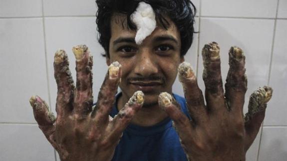 El 'hombre árbol' de Bangladesh posa con sus nuevas manos tras varias operaciones. 
