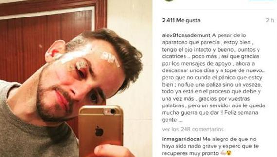 Le rompen un vaso en la cara a Álex Casademunt y le desfiguran el rostro