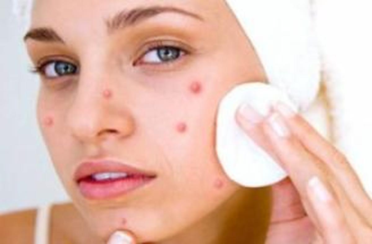 El acné, un problema que no solo afecta a los adolescentes