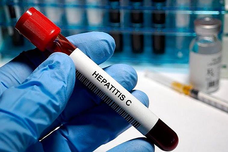 La hepatitis es una inflamación del hígado causada por una infección vírica.