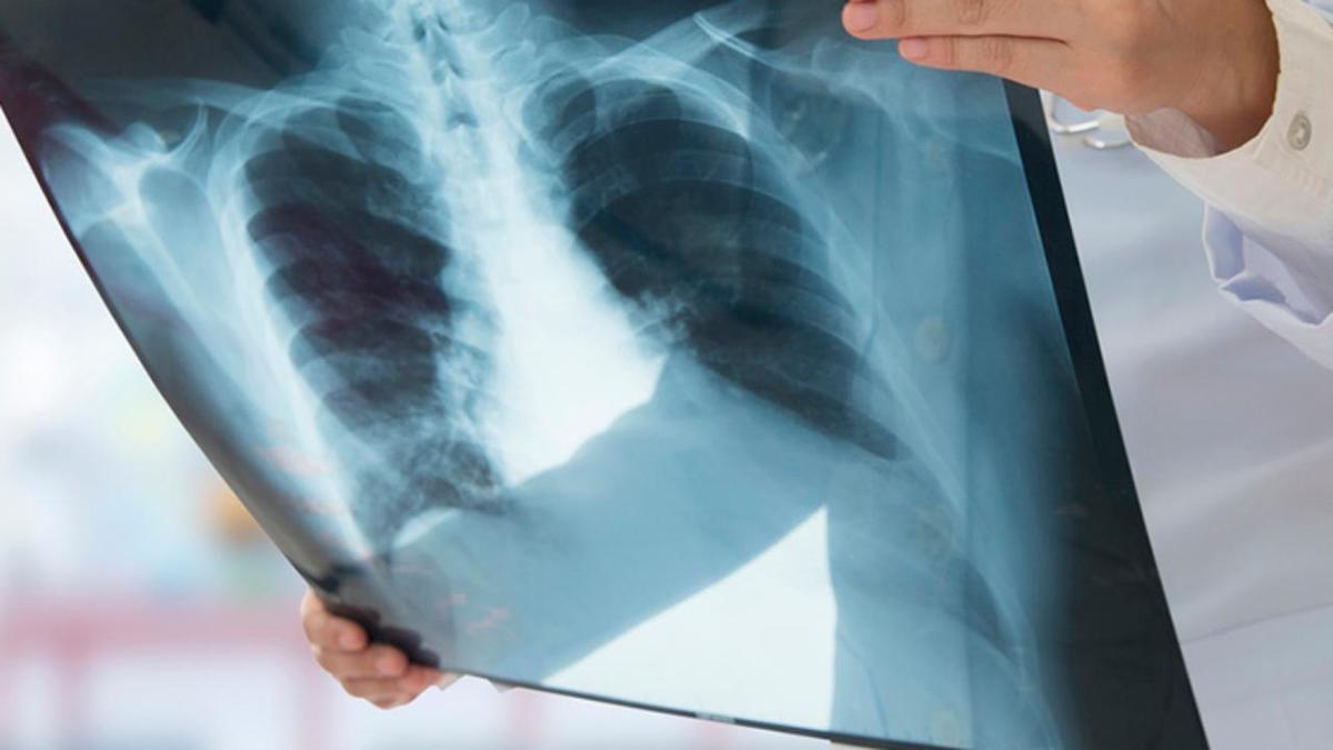 Radiografía de unos pulmones.