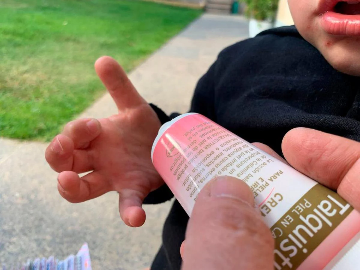 Un padre administra crema para calmar el picor en las manos de un niño que ha contraído la enfermedad.