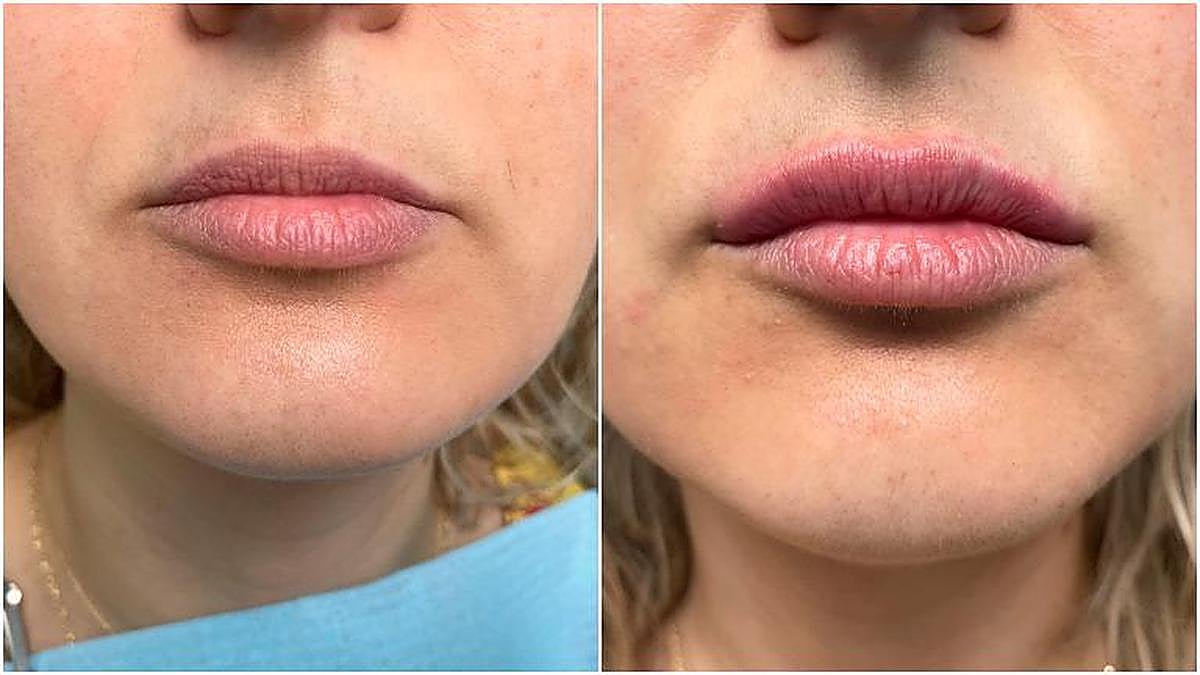 Antes y después de un tratamiento de aumento de labios con ácido hialurónico.