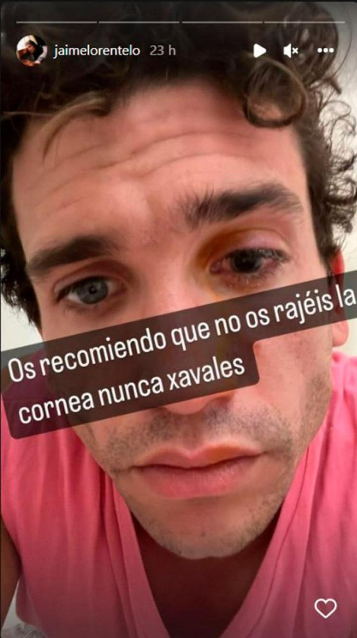 Historia en Instagram de Jaime Lorente mostrando su lesión. | INSTRAGRAM JAIME LORENTE