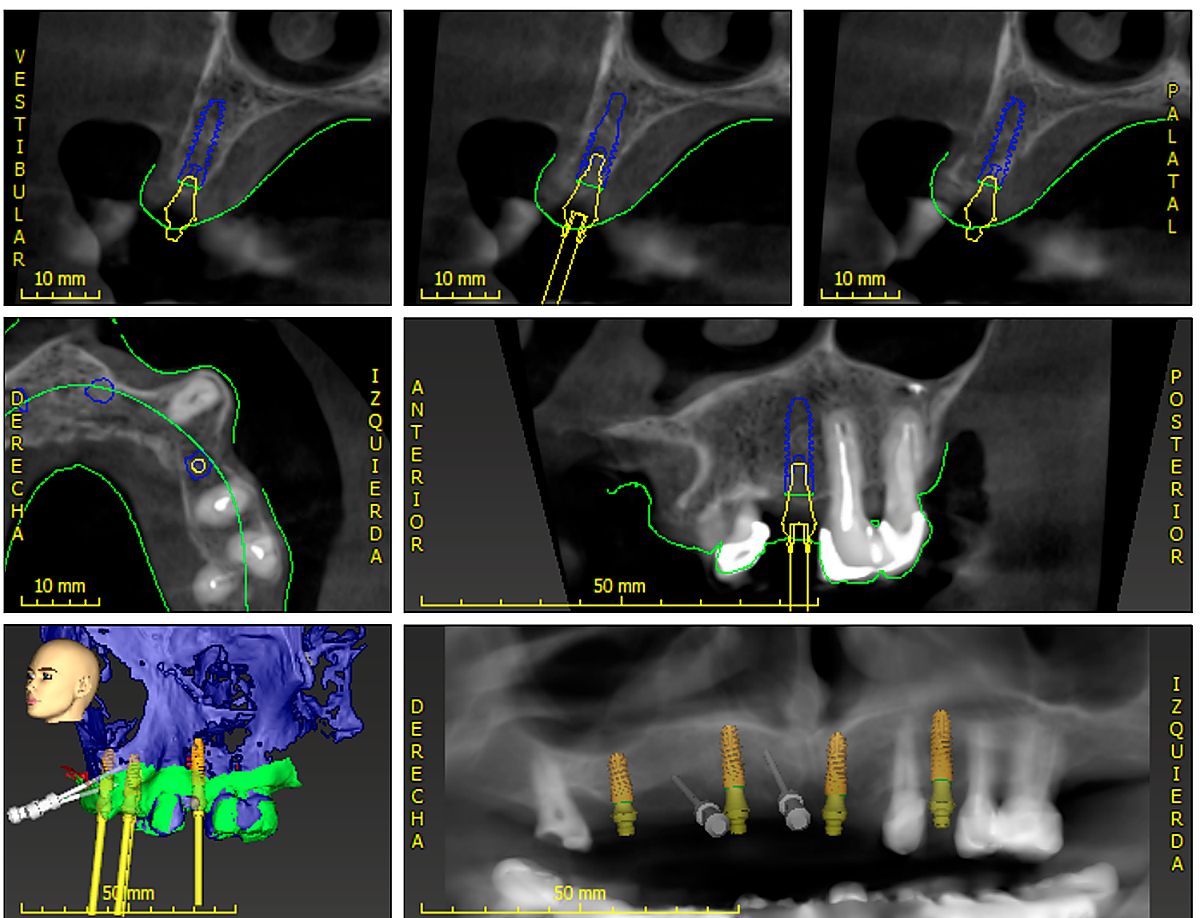 PASO 2. Planificación previa por ordenador de la colocación de los implantes.