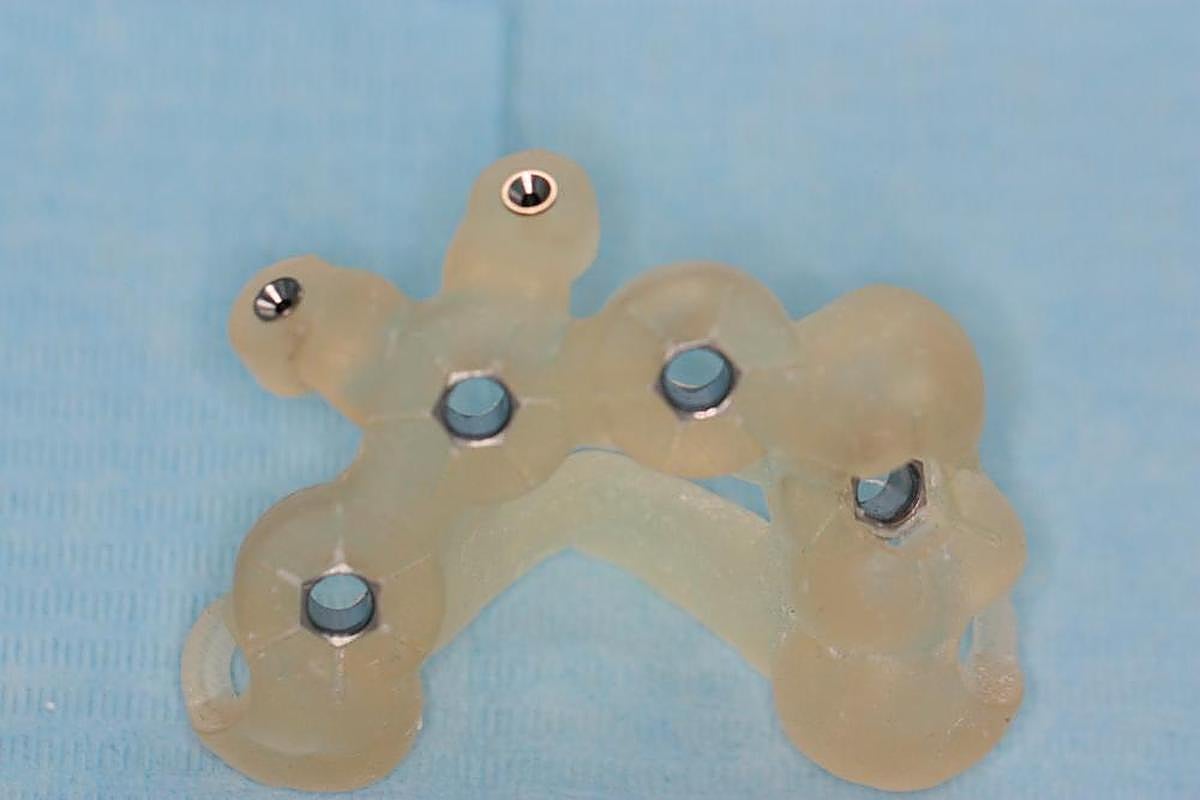 PASO 3. Elaboración de la férula o prótesis que servirá de guía para colocar los implantes.