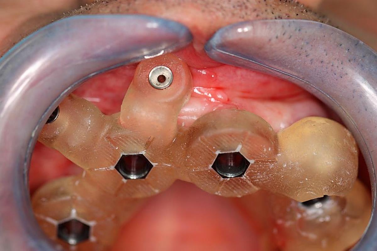 PASO 5. Colocación de la férula en la boca para atornillar el cuerpo del implante y el pilar.