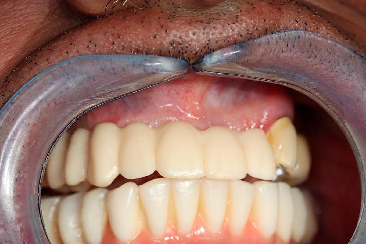 PASO 7. El paciente con las coronas ya colocadas.