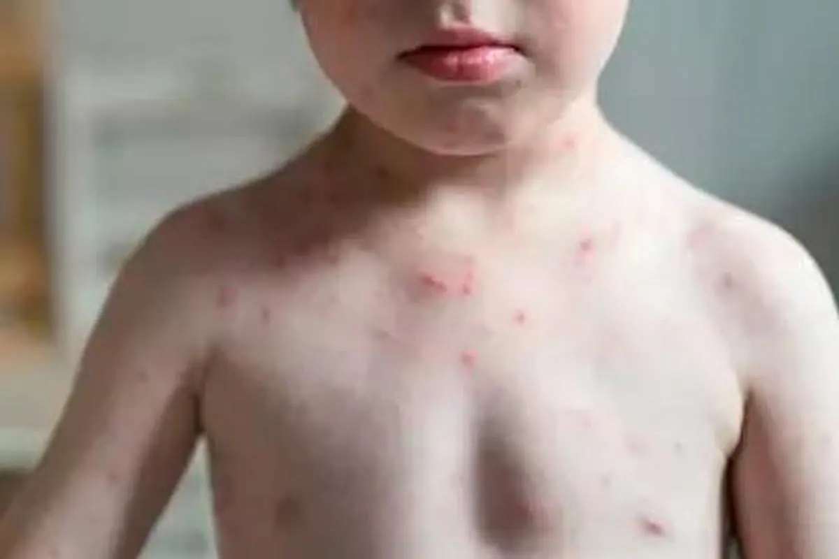 Un niño contagiado de varicela.