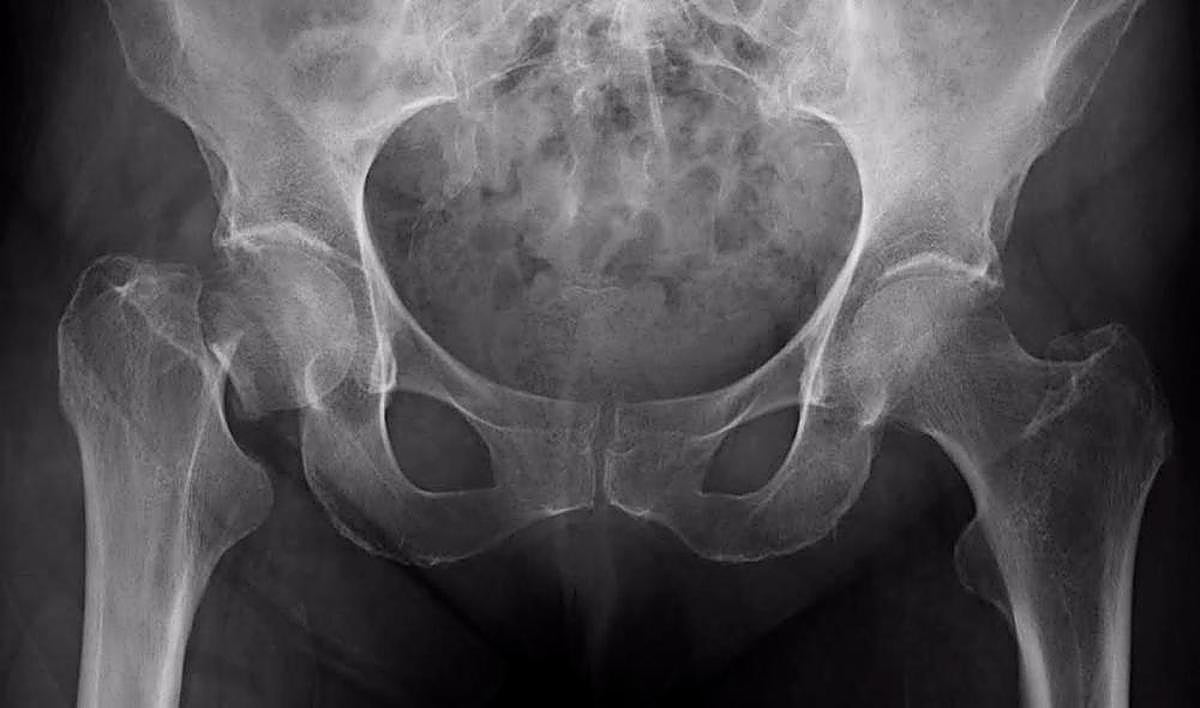 Radiografía de una cadera