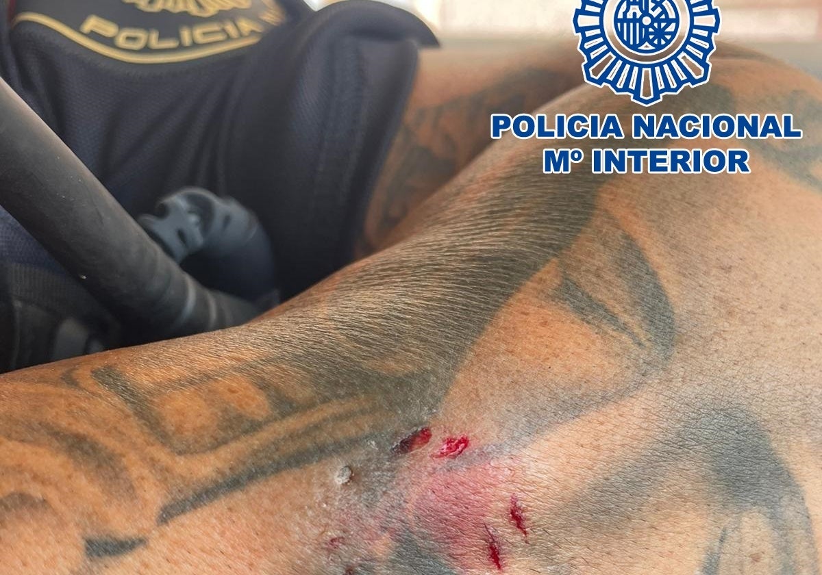 Herida de uno de los policías que mordió la mujer.