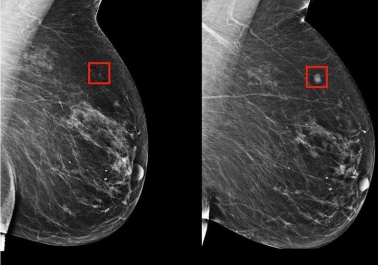La Inteligencia Artificial detecta el cáncer de mama cinco años antes de su desarrollo