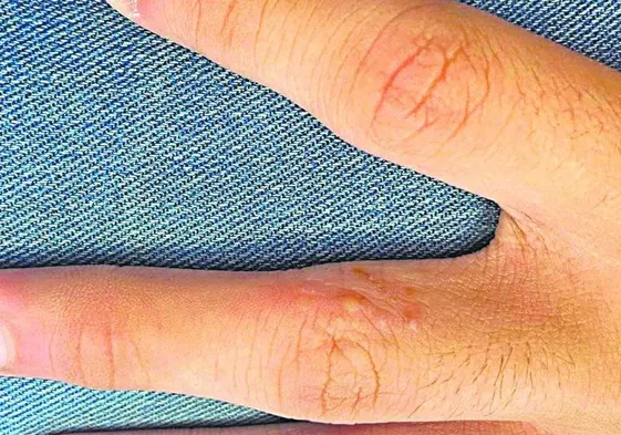 Imagen de una lesión producida por la sarna en el dedo de un paciente.