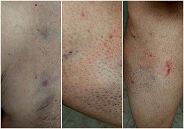 Imágenes de las heridas sufridas por los funcionarios del centro penitenciario de Topas.