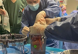 El corazón de la donación en asistolia, en un momento de la intervención.