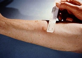 Un paciente es sometido a una prueba de detección para el diagnóstico de la tuberculosis. AFP