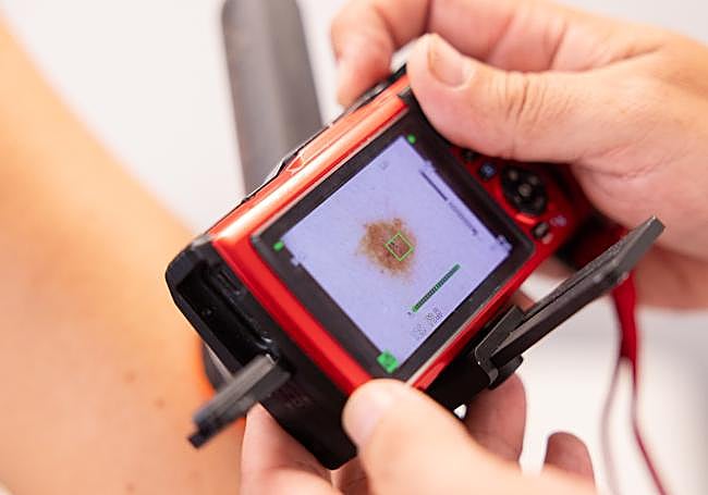 Imagen dermatoscópica tomada en la consulta de Primaria.