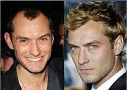 El actor Jude Law, antes y después del injerto. / Archivo