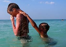 La psoriasis y sus implicaciones