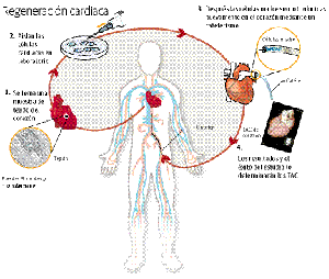 El corazón infartado puede repararse  solo con una inyección de células