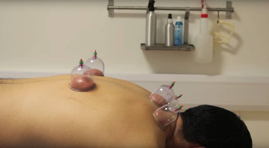 Las ventosas se dejan unos 10 minutos sobre la piel.