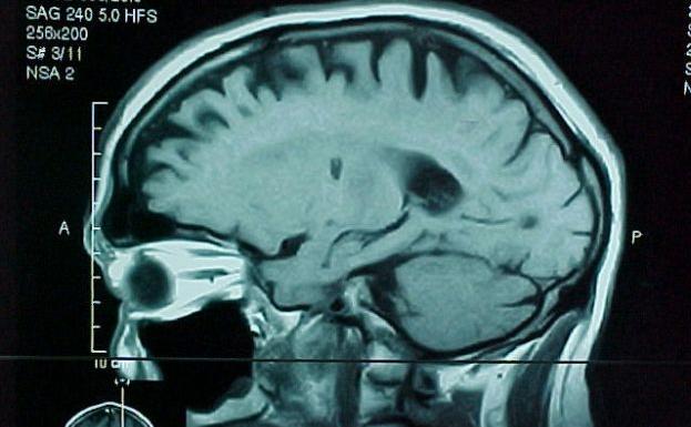 El descubrimiento valenciano que puede ayudar a controlar el tumor cerebral