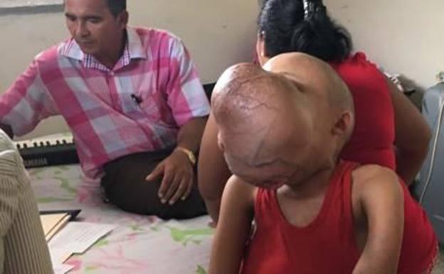 Muere el niño cubano al que le extirparon un tumor facial de 4,5 kilos