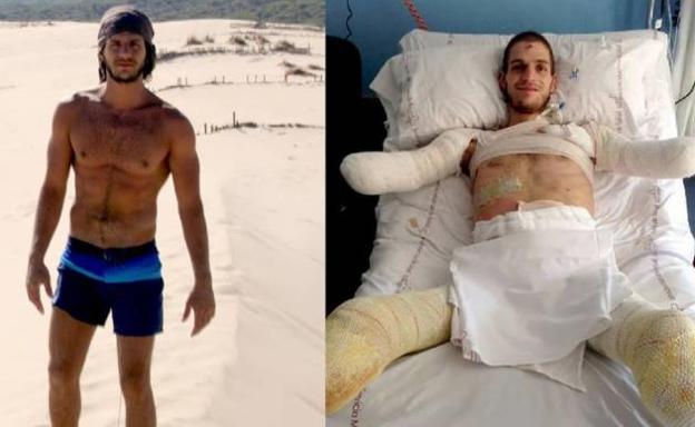 Davide, amputado de brazos y piernas, pide ayuda para una prótesis biónica