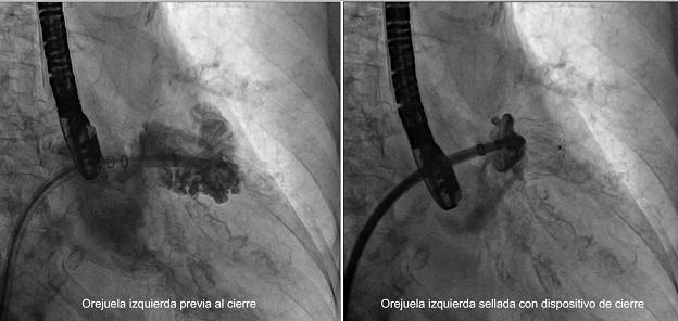 La Unidad de Hemodinámica de Quirónsalud Valencia realiza el primer cierre percutáneo de orejuela izquierda de la sanidad privada valenciana