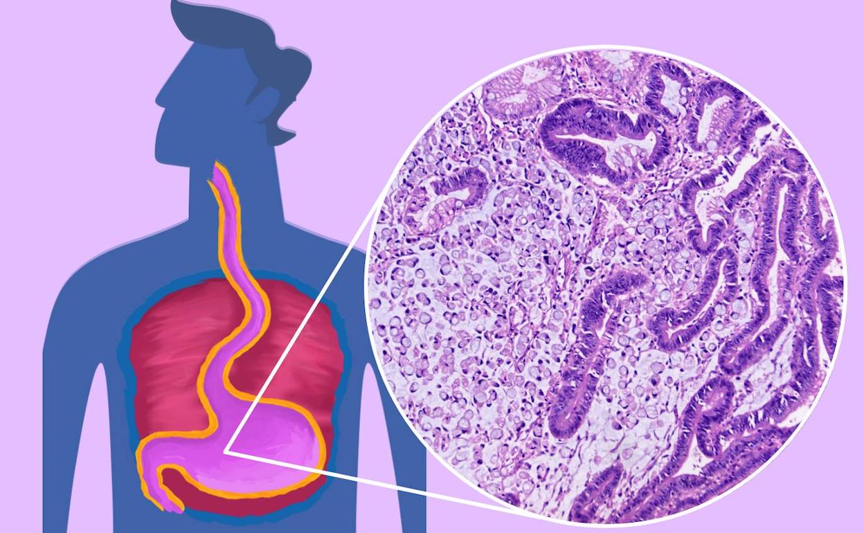 Ilustración sobre el cáncer gástrico remitida por Incliva.